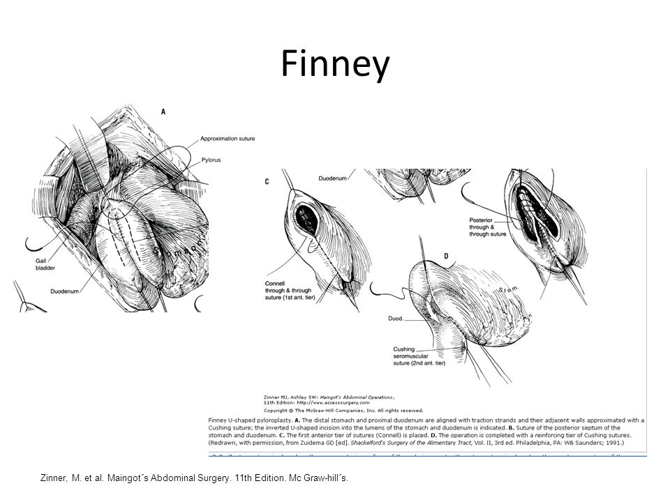 Finney Zinner, M. et al. Maingot´s Abdominal Surgery. 11th Edition. Mc Graw-hill´s.