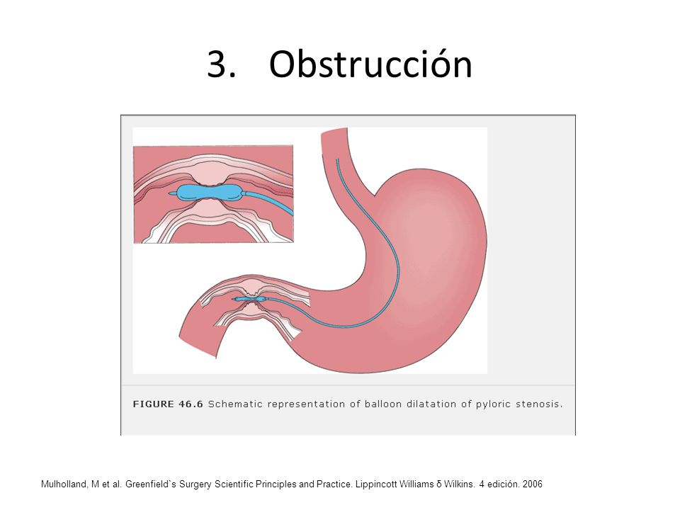 Obstrucción Mulholland, M et al. Greenfield`s Surgery Scientific Principles and Practice.