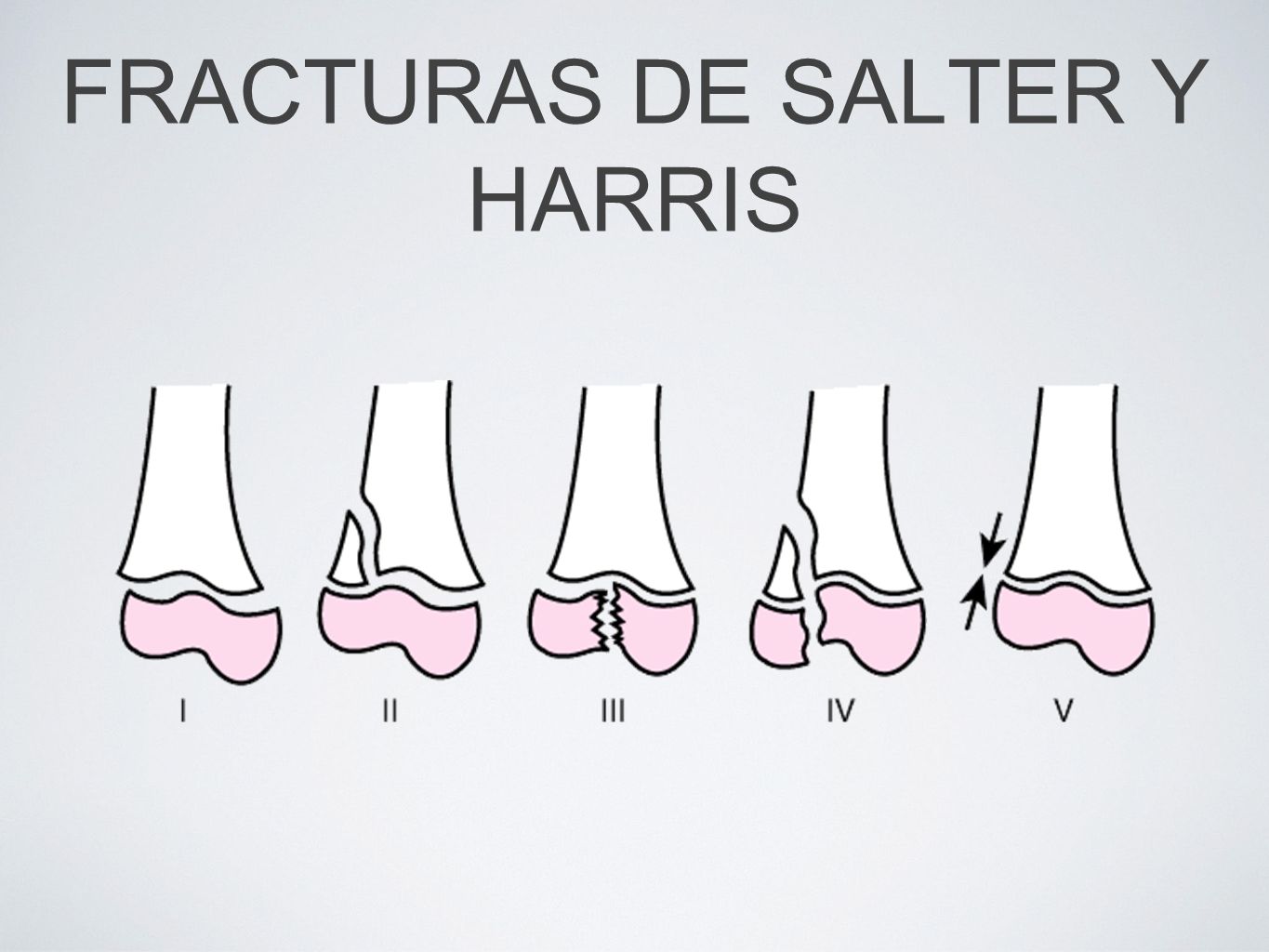 FRACTURAS DE SALTER Y HARRIS