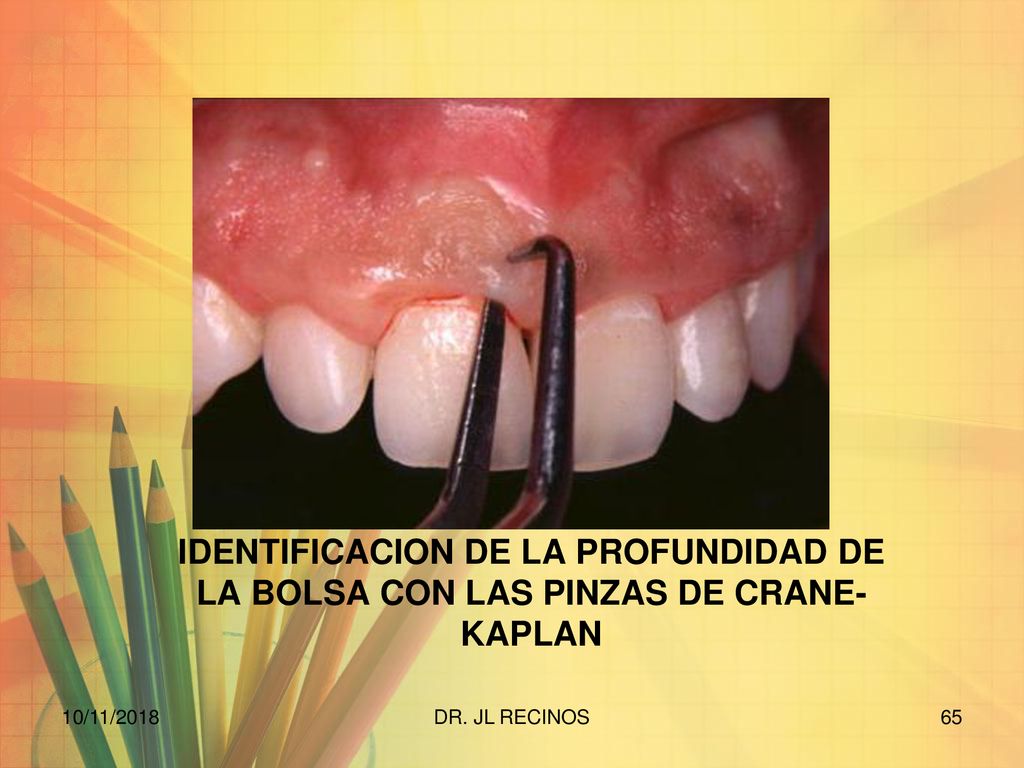 IDENTIFICACION DE LA PROFUNDIDAD DE LA BOLSA CON LAS PINZAS DE CRANE-KAPLAN
