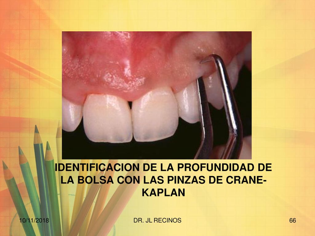 IDENTIFICACION DE LA PROFUNDIDAD DE LA BOLSA CON LAS PINZAS DE CRANE-KAPLAN
