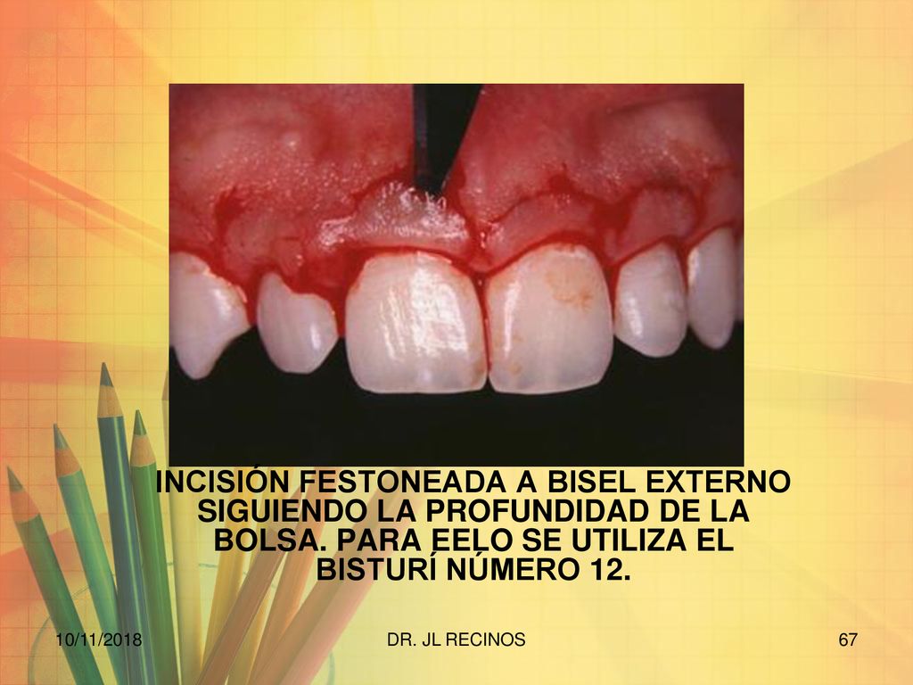 INCISIÓN FESTONEADA A BISEL EXTERNO SIGUIENDO LA PROFUNDIDAD DE LA BOLSA. PARA EELO SE UTILIZA EL BISTURÍ NÚMERO 12.