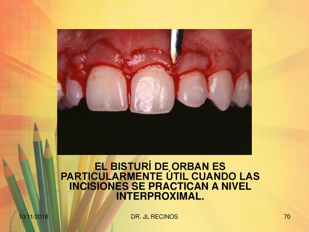 EL BISTURÍ DE ORBAN ES PARTICULARMENTE ÚTIL CUANDO LAS INCISIONES SE PRACTICAN A NIVEL INTERPROXIMAL.
