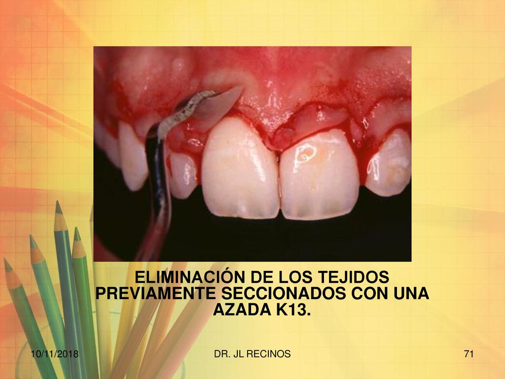 ELIMINACIÓN DE LOS TEJIDOS PREVIAMENTE SECCIONADOS CON UNA AZADA K13.
