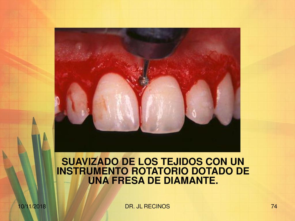 SUAVIZADO DE LOS TEJIDOS CON UN INSTRUMENTO ROTATORIO DOTADO DE UNA FRESA DE DIAMANTE.