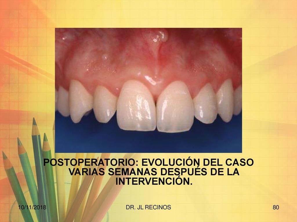 POSTOPERATORIO: EVOLUCIÓN DEL CASO VARIAS SEMANAS DESPUÉS DE LA INTERVENCIÓN.