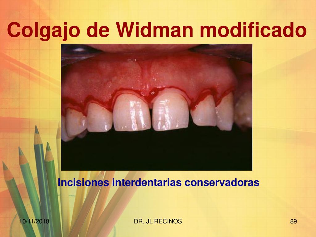 Colgajo de Widman modificado Incisiones interdentarias conservadoras