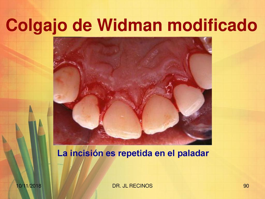 Colgajo de Widman modificado La incisión es repetida en el paladar