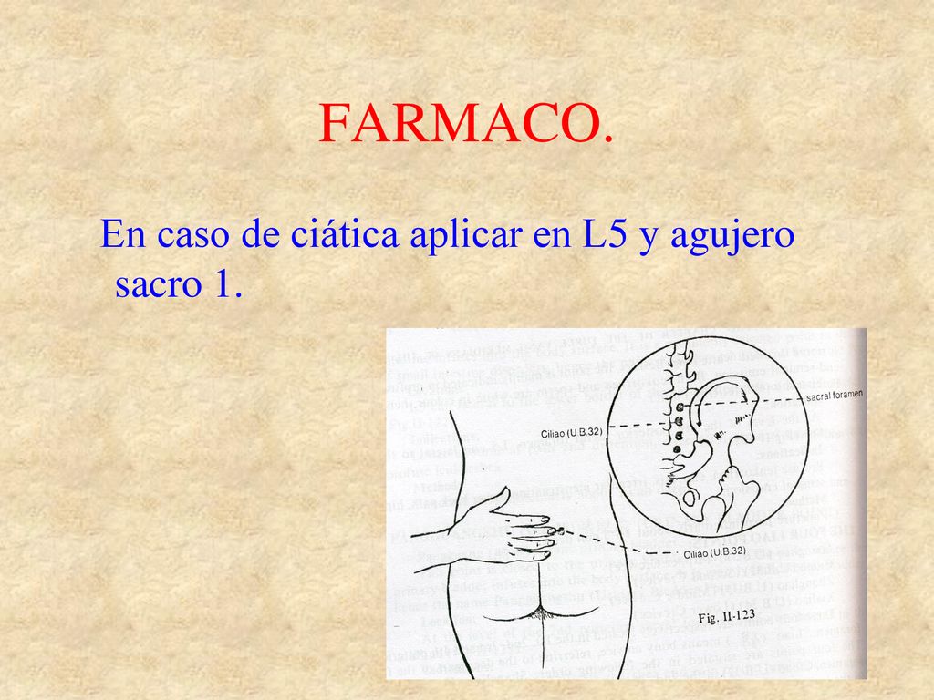 FARMACO. En caso de ciática aplicar en L5 y agujero sacro 1.
