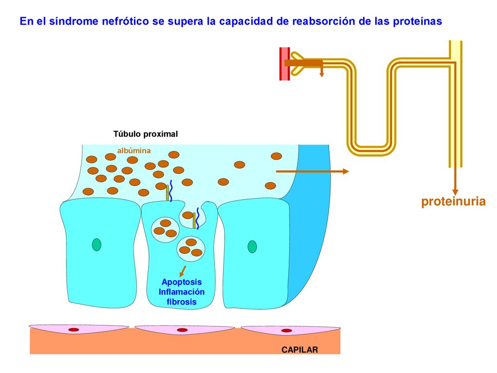 En el síndrome nefrótico se supera la capacidad de reabsorción de las proteínas