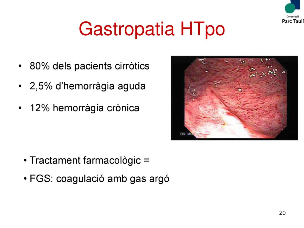 Gastropatia HTpo 80% dels pacients cirròtics 2,5% d’hemorràgia aguda
