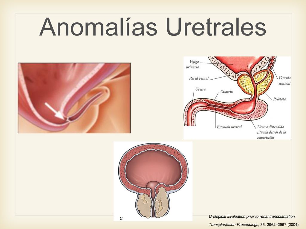 Anomalías Uretrales valvas uretrales posteriores, estenosis de uretra, hiperplasia prostatica. Urological Evaluation prior to renal transplantation.