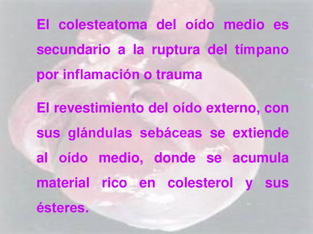 El colesteatoma del oído medio es secundario a la ruptura del tímpano por inflamación o trauma
