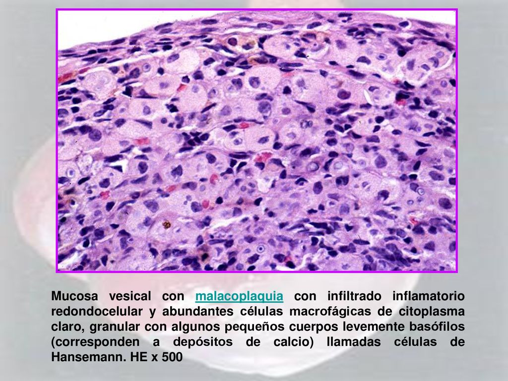 Mucosa vesical con malacoplaquia con infiltrado inflamatorio redondocelular y abundantes células macrofágicas de citoplasma claro, granular con algunos pequeños cuerpos levemente basófilos (corresponden a depósitos de calcio) llamadas células de Hansemann.