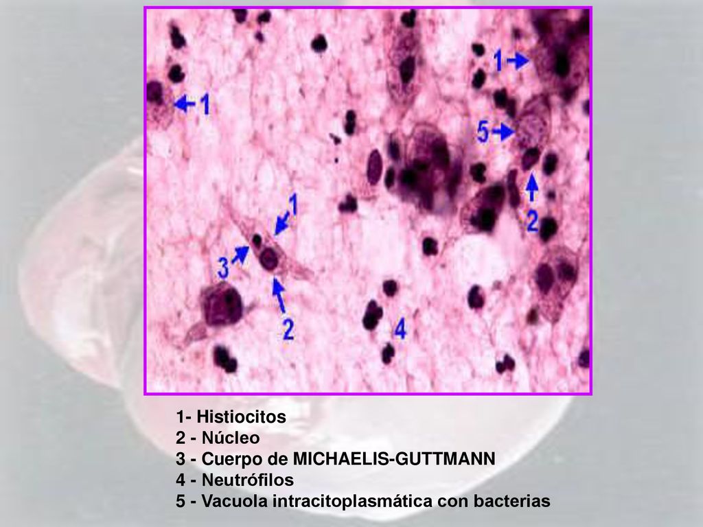 1- Histiocitos 2 - Núcleo 3 - Cuerpo de MICHAELIS-GUTTMANN 4 - Neutrófilos 5 - Vacuola intracitoplasmática con bacterias