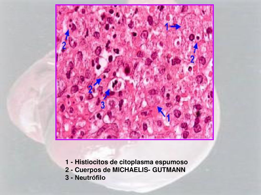 1 - Histiocitos de citoplasma espumoso 2 - Cuerpos de MICHAELIS- GUTMANN 3 - Neutrófilo