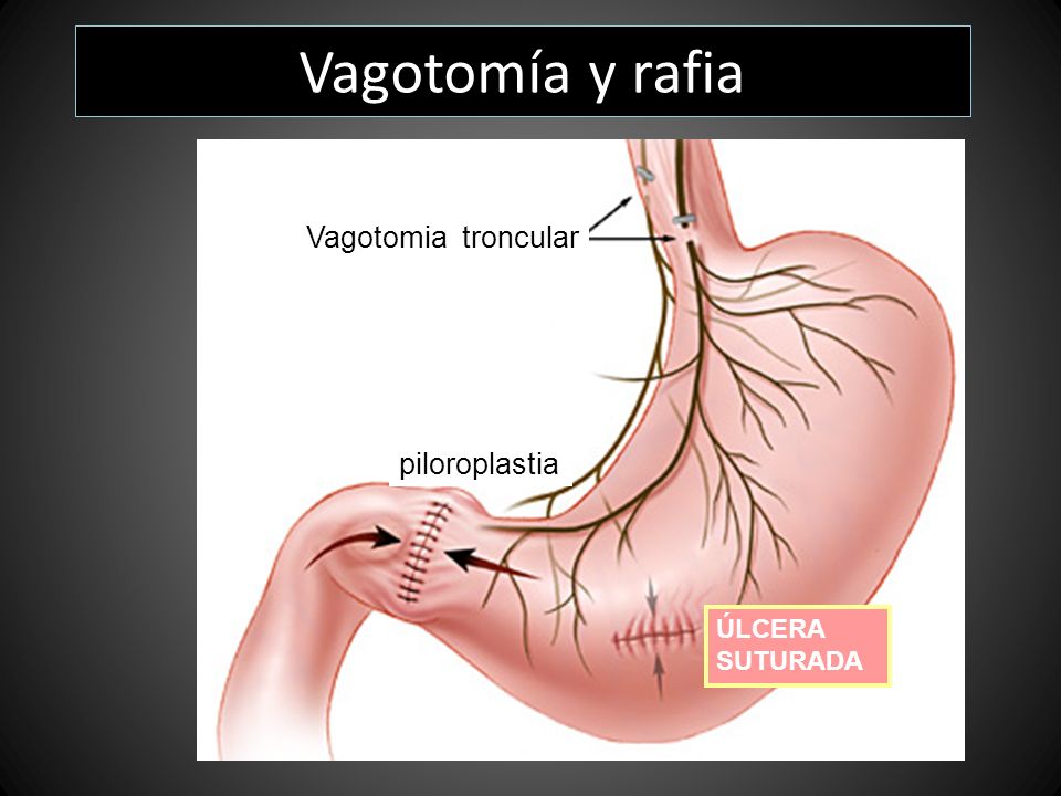 Vagotomía y rafia Vagotomia troncular piloroplastia ÚLCERA SUTURADA