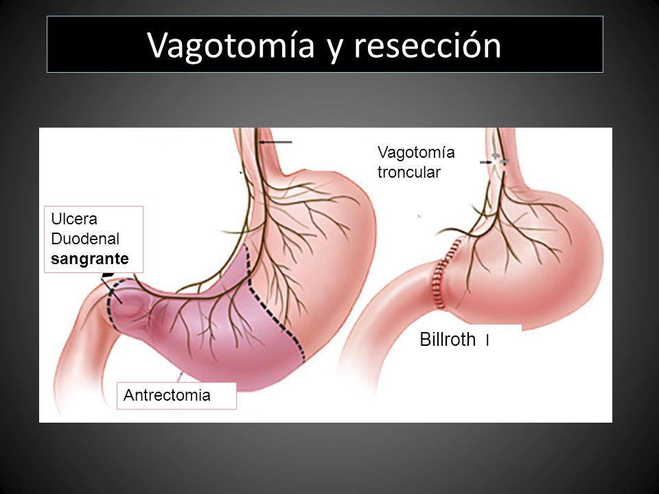 Vagotomía y resección Billroth I Vagotomía troncular