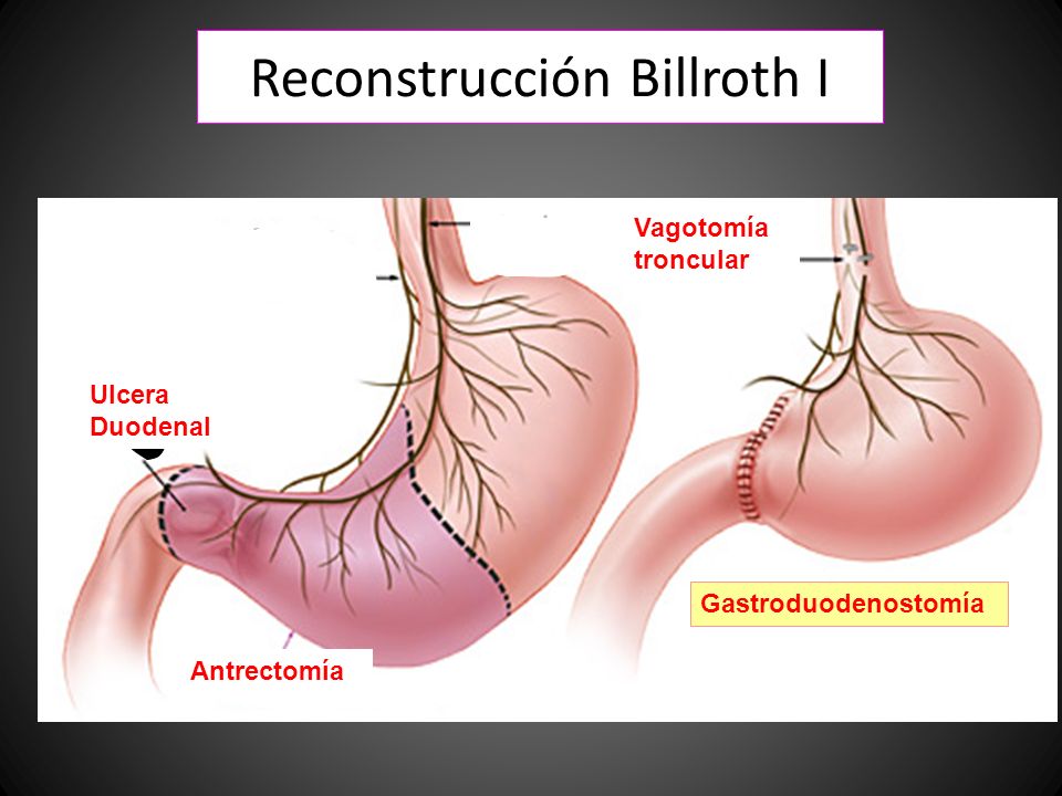 Reconstrucción Billroth I