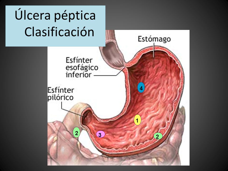 Úlcera péptica Clasificación