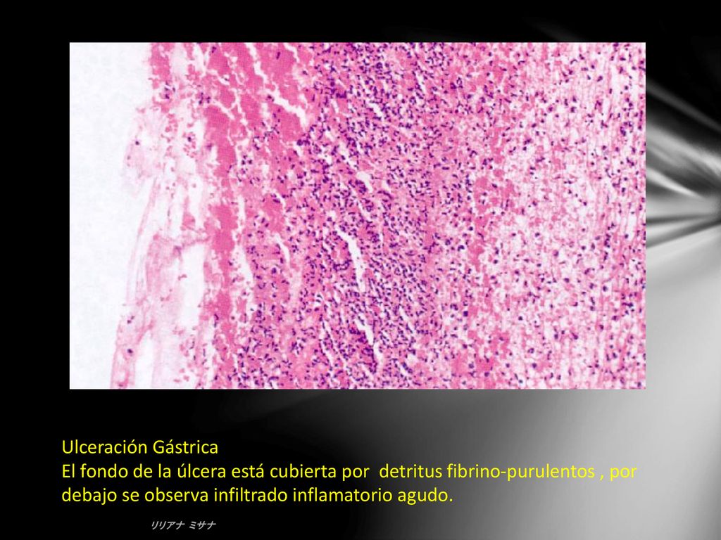 Ulceración Gástrica El fondo de la úlcera está cubierta por detritus fibrino-purulentos , por debajo se observa infiltrado inflamatorio agudo.