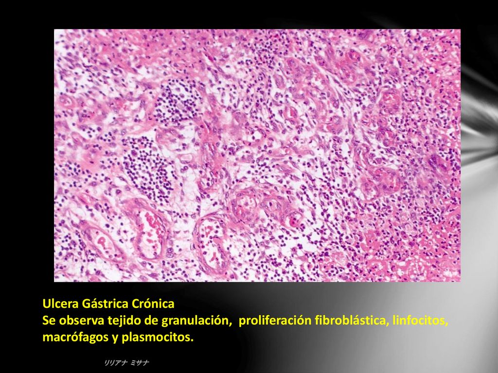 Ulcera Gástrica Crónica Se observa tejido de granulación, proliferación fibroblástica, linfocitos, macrófagos y plasmocitos.