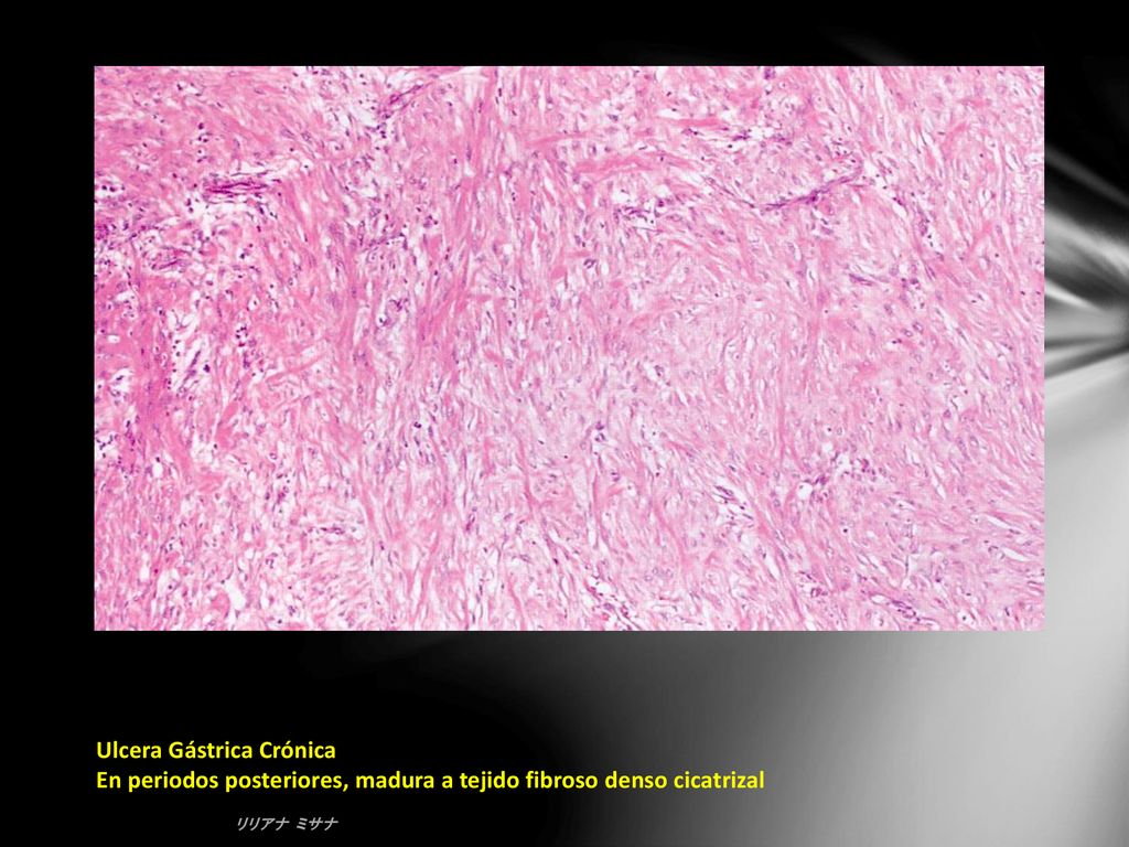 Ulcera Gástrica Crónica En periodos posteriores, madura a tejido fibroso denso cicatrizal