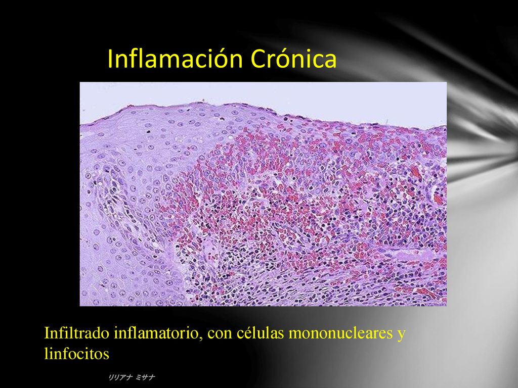 Inflamación Crónica Infiltrado inflamatorio, con células mononucleares y linfocitos リリアナ ミサナ