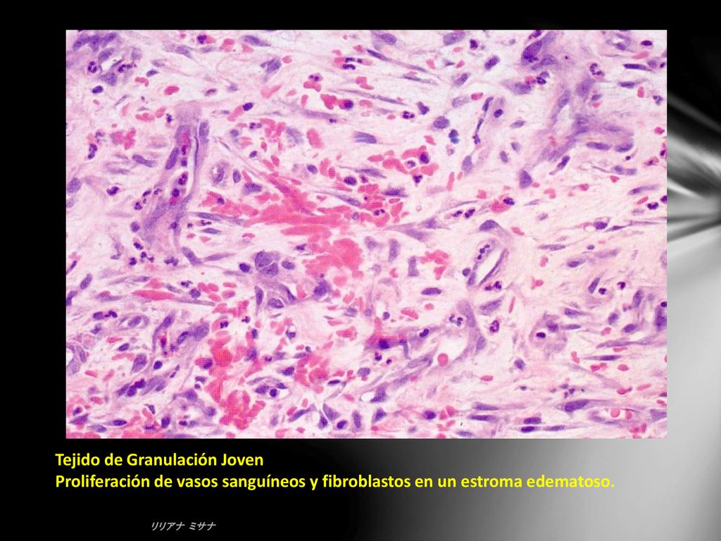 Tejido de Granulación Joven Proliferación de vasos sanguíneos y fibroblastos en un estroma edematoso.