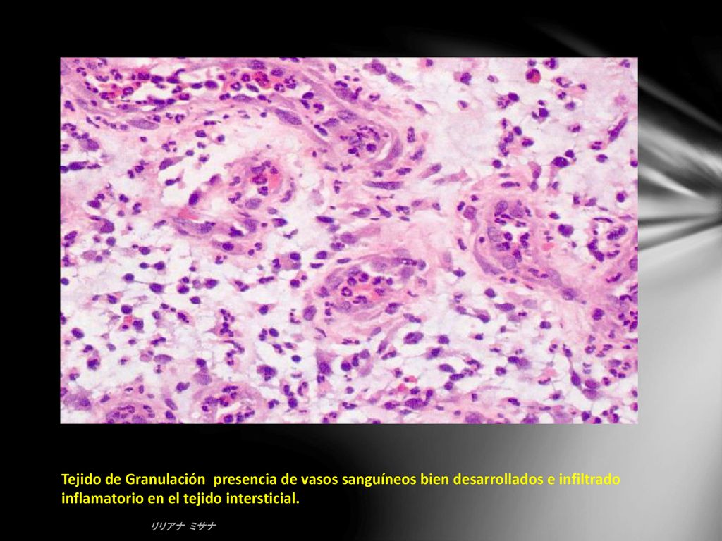 Tejido de Granulación presencia de vasos sanguíneos bien desarrollados e infiltrado inflamatorio en el tejido intersticial.