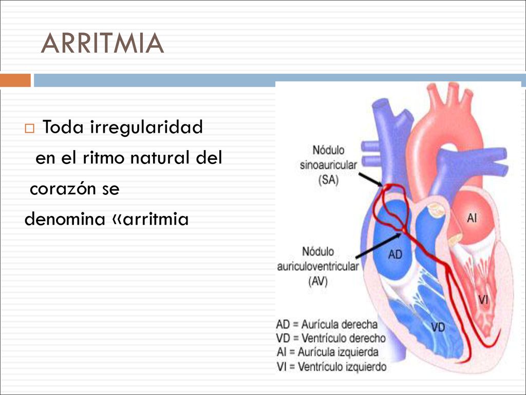 ARRITMIA Toda irregularidad en el ritmo natural del corazón se