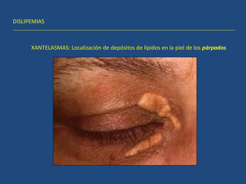 DISLIPEMIAS XANTELASMAS: Localización de depósitos de lípidos en la piel de los párpados