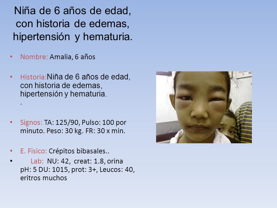 Niña de 6 años de edad, con historia de edemas, hipertensión y hematuria.