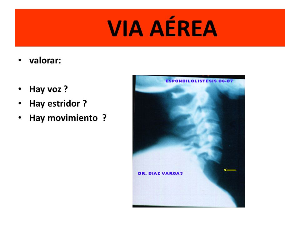 VIA AÉREA valorar: Hay voz Hay estridor Hay movimiento