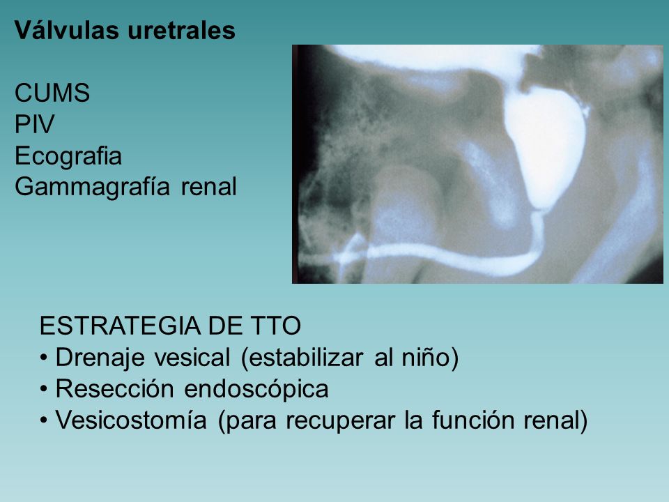 Válvulas uretrales CUMS. PIV. Ecografia. Gammagrafía renal. ESTRATEGIA DE TTO. Drenaje vesical (estabilizar al niño)