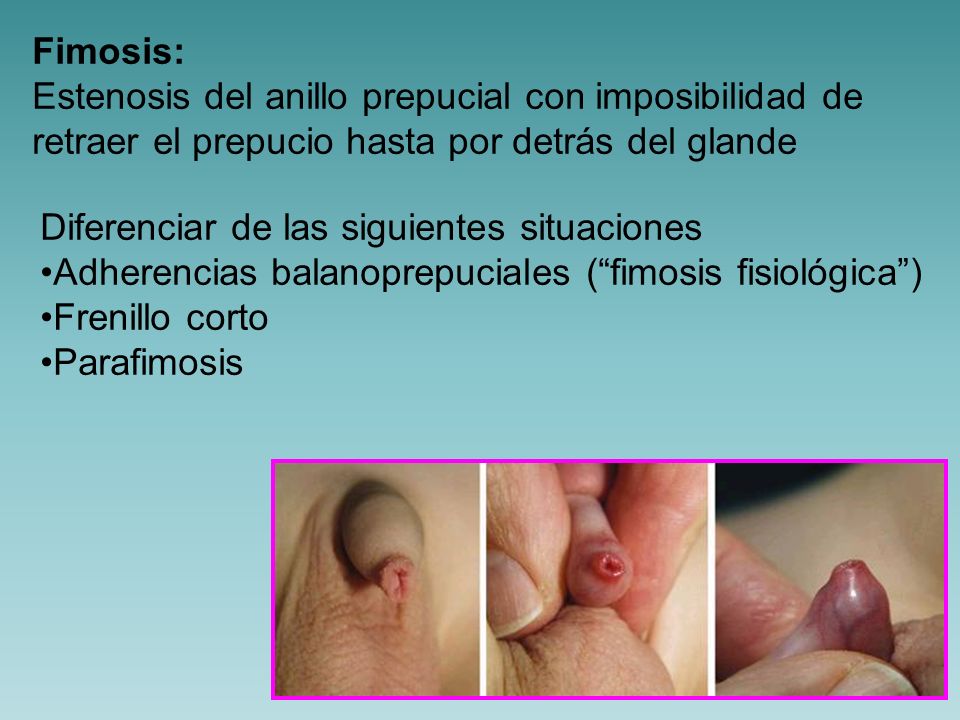 Fimosis: Estenosis del anillo prepucial con imposibilidad de. retraer el prepucio hasta por detrás del glande.