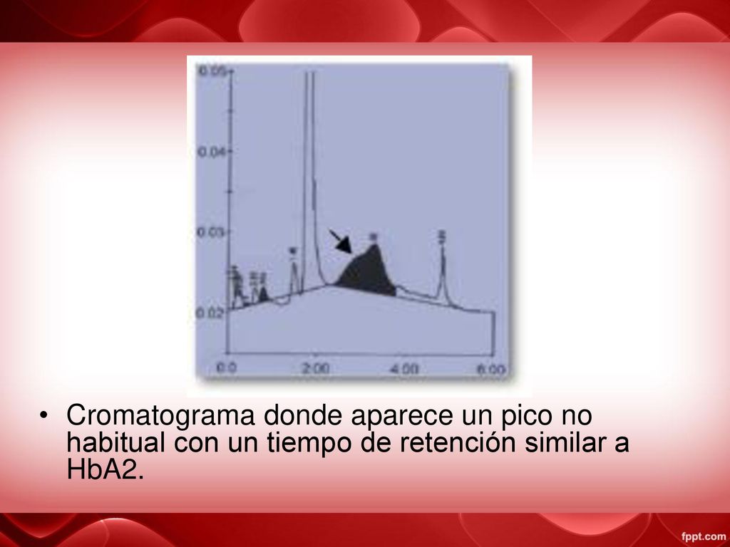 Cromatograma donde aparece un pico no habitual con un tiempo de retención similar a HbA2.