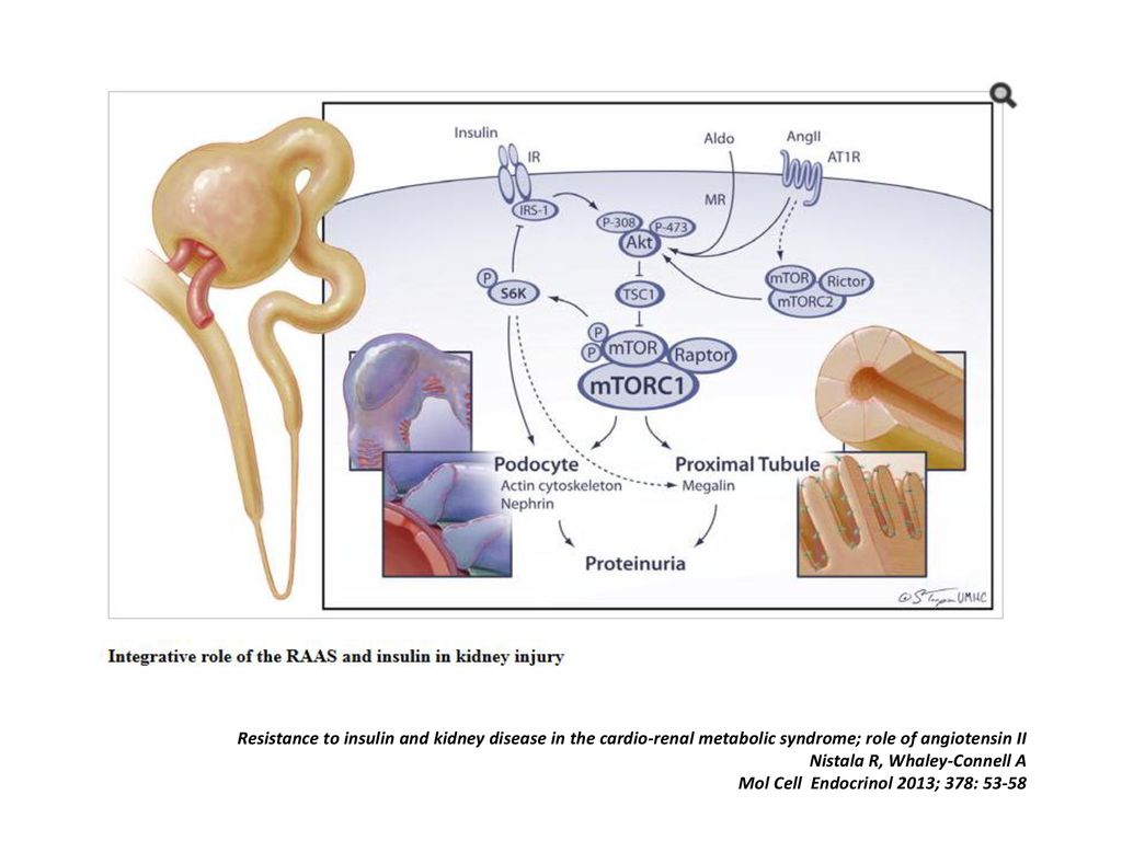 Resistance to insulin and kidney disease in the cardio-renal metabolic syndrome; role of angiotensin II