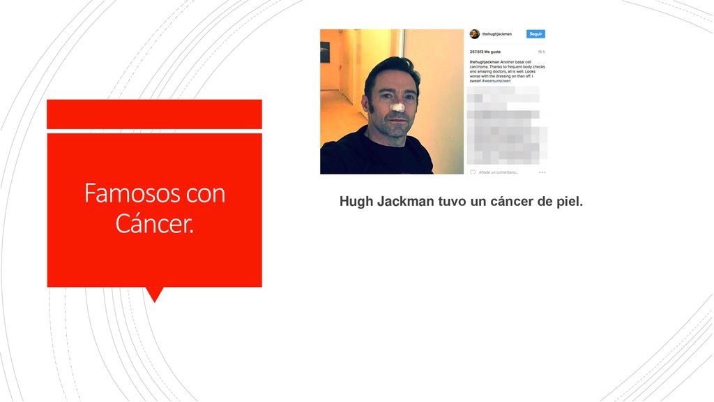 Famosos con Cáncer. Hugh Jackman tuvo un cáncer de piel.