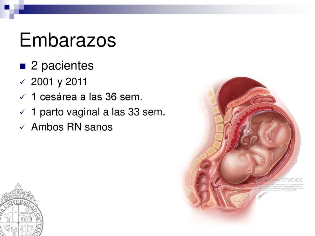 Embarazos 2 pacientes 2001 y cesárea a las 36 sem.