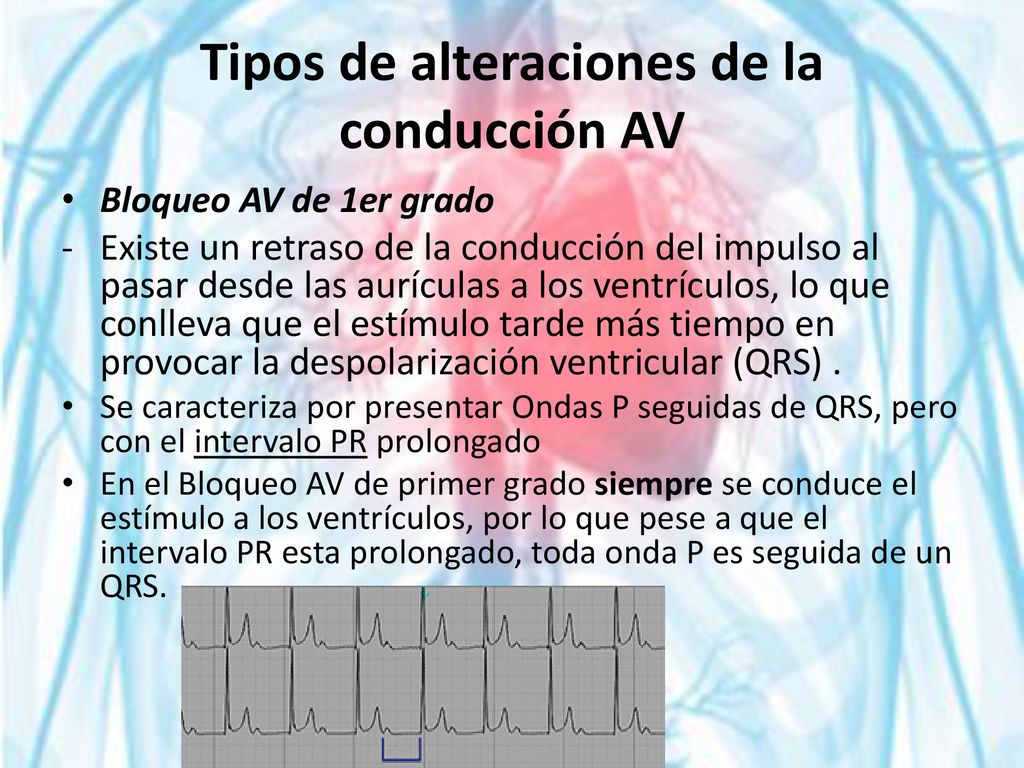 Tipos de alteraciones de la conducción AV