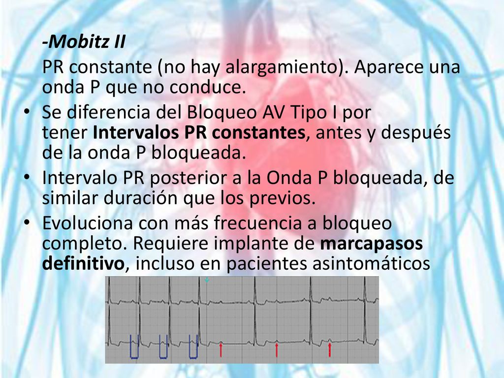 -Mobitz II PR constante (no hay alargamiento). Aparece una onda P que no conduce.