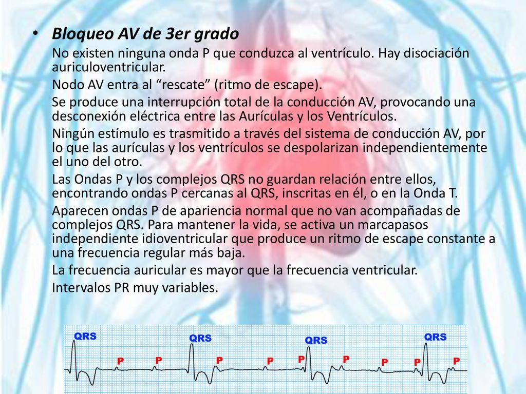 Bloqueo AV de 3er grado Nodo AV entra al rescate (ritmo de escape).