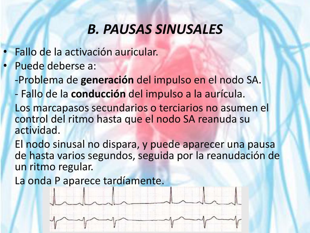 B. PAUSAS SINUSALES Fallo de la activación auricular. Puede deberse a: