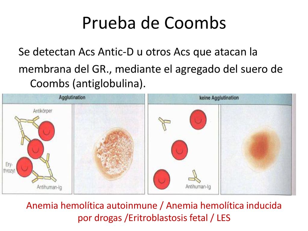 Prueba de Coombs Se detectan Acs Antic-D u otros Acs que atacan la membrana del GR., mediante el agregado del suero de Coombs (antiglobulina).