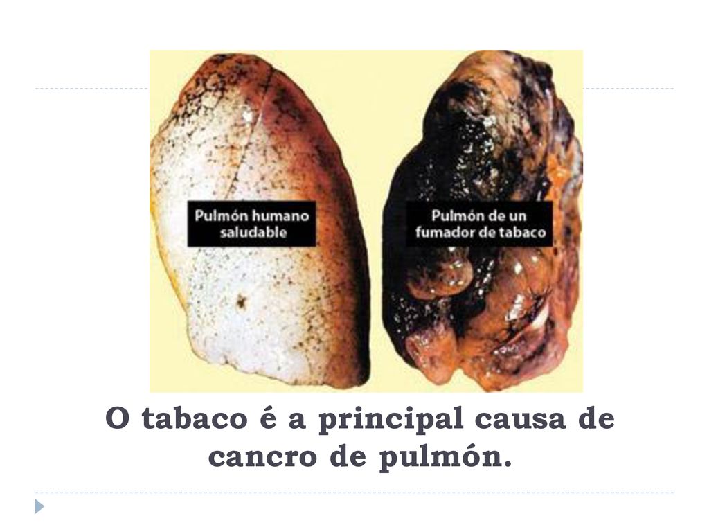 O tabaco é a principal causa de cancro de pulmón.