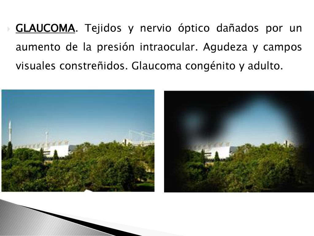 GLAUCOMA. Tejidos y nervio óptico dañados por un aumento de la presión intraocular.