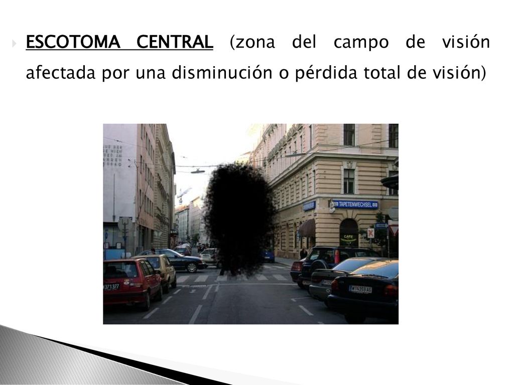 ESCOTOMA CENTRAL (zona del campo de visión afectada por una disminución o pérdida total de visión)