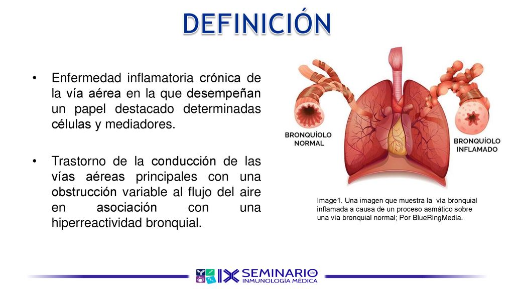 DEFINICIÓN Enfermedad inflamatoria crónica de la vía aérea en la que desempeñan un papel destacado determinadas células y mediadores.