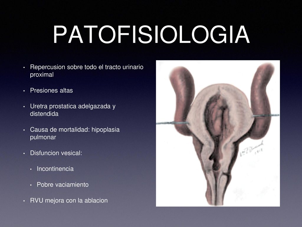 PATOFISIOLOGIA hipoplasia pulmonar causa mas importante de mortalidad